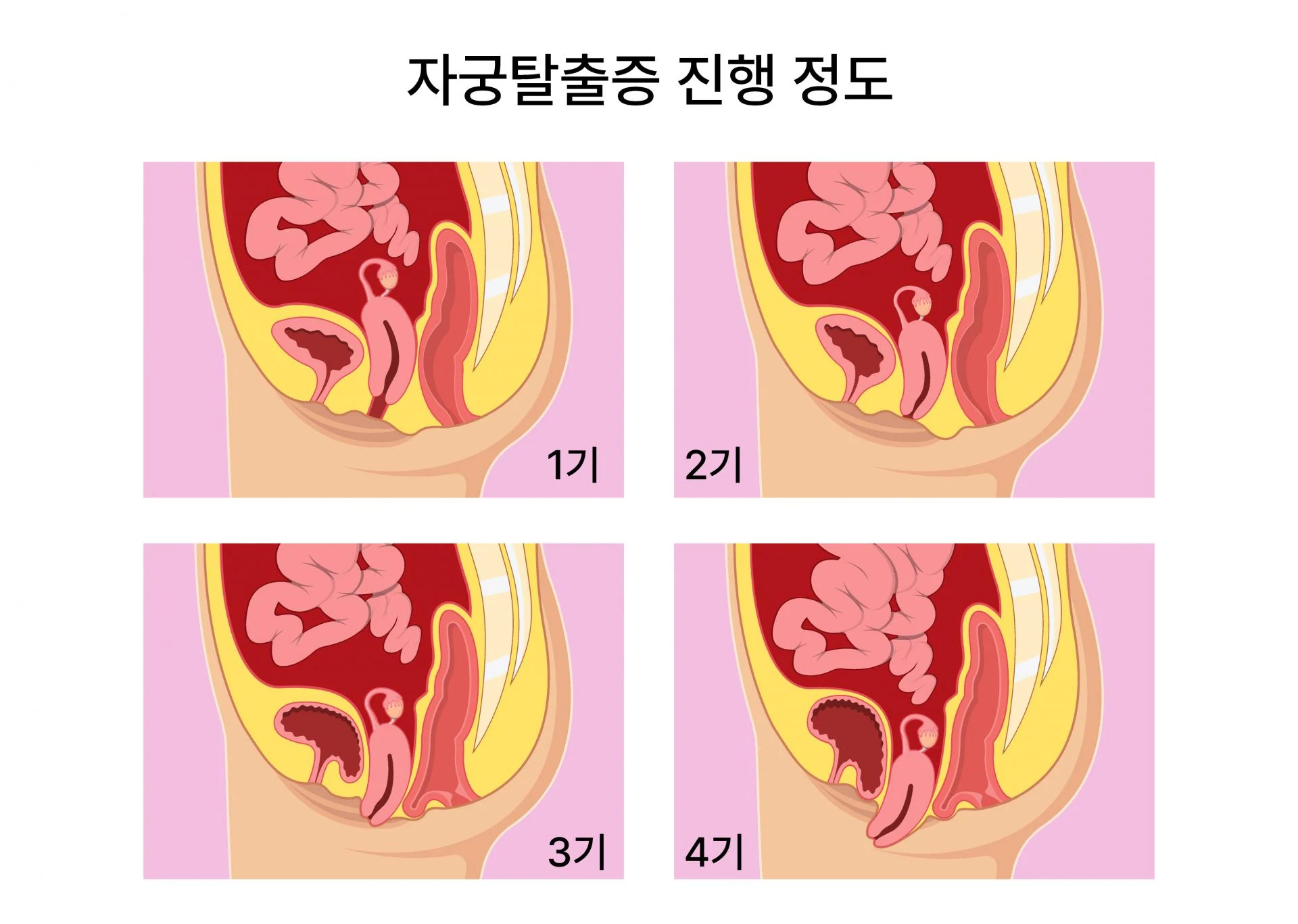 자주 쪼그려 앉지 마세요, 자궁탈출증 — 차차여성의원 내몸이야기 이미지 2
